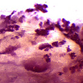 2014_06_27_tumor woMTDH_120 2014_06_27_tumor woMTDH_120